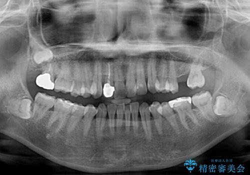 前歯のデコボコとむし歯治療の跡 インビザライン矯正とオールセラミッククラウン治療の治療前
