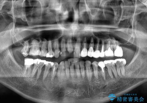 受け口傾向の咬み合わせを治したい 全顎セラミック治療の治療前