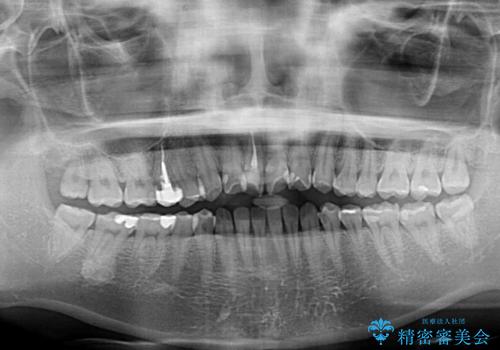 捻れた前歯を楽して改善 ワイヤー装置での非抜歯矯正の治療前