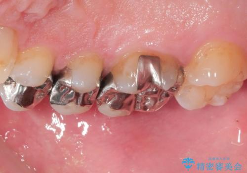 銀歯をセラミックに変えたいの治療前