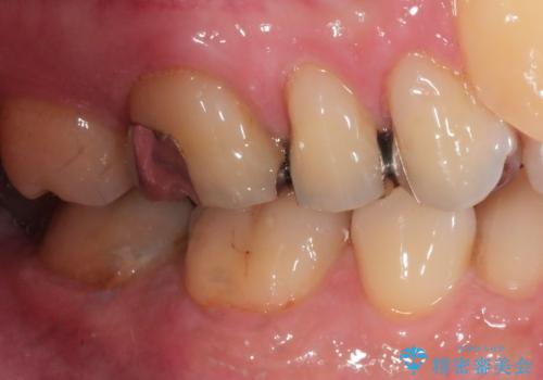 銀歯をセラミックに変えたいの症例 治療前