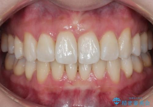 再矯正の症例 治療後