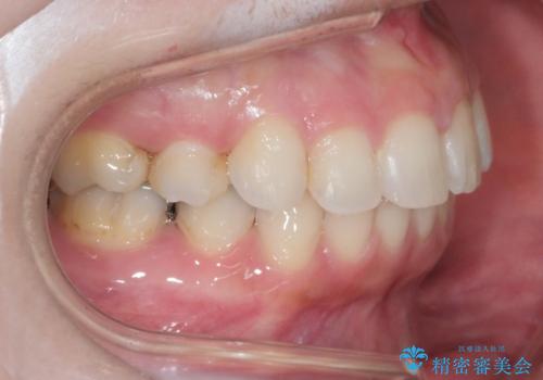 前歯のガタつきを改善 抜歯矯正後の後戻りの治療後