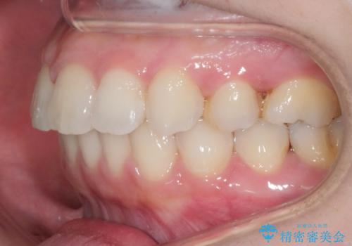 前歯のガタつきを改善 抜歯矯正後の後戻りの治療後