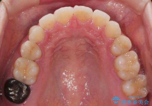 前歯のガタつきを改善 抜歯矯正後の後戻りの治療後