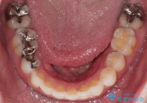 前歯のガタつきを改善 抜歯矯正後の後戻りの治療後