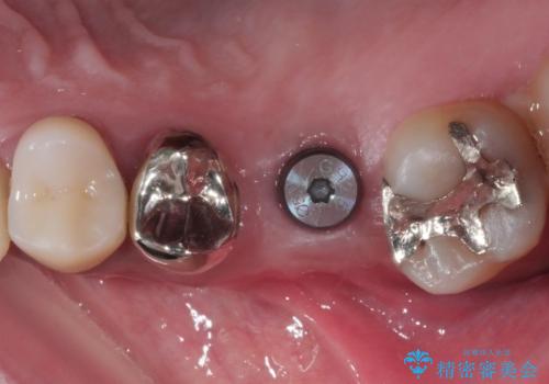 奥歯のインプラント治療の治療中