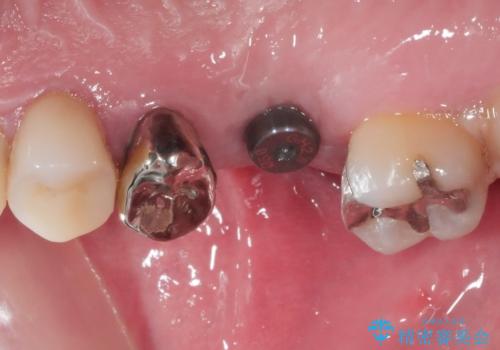 奥歯のインプラント治療の治療中