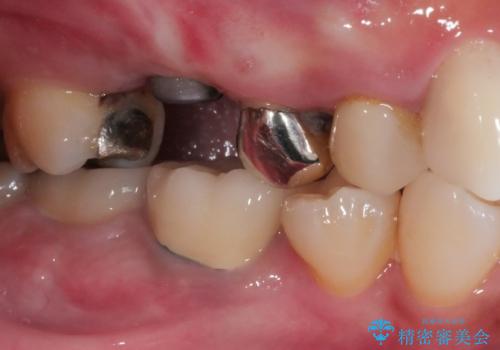 奥歯のインプラント治療の治療中