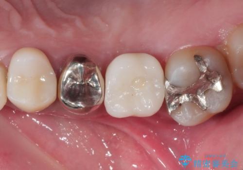 奥歯のインプラント治療の治療後