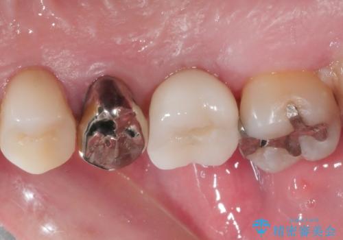 奥歯のインプラント治療の治療後