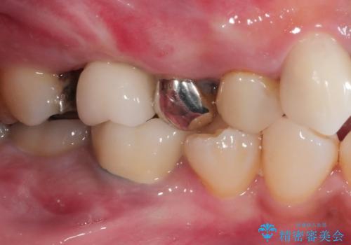奥歯のインプラント治療の治療後
