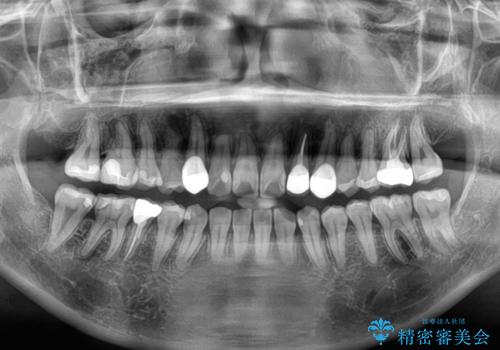 むし歯と八重歯を治したい 総合歯科治療の治療後
