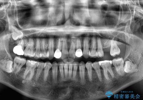 前歯のデコボコとむし歯治療の跡 インビザライン矯正とオールセラミッククラウン治療の治療後