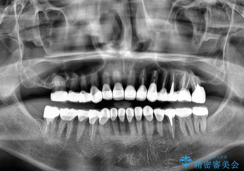 受け口傾向の咬み合わせを治したい 全顎セラミック治療の治療後