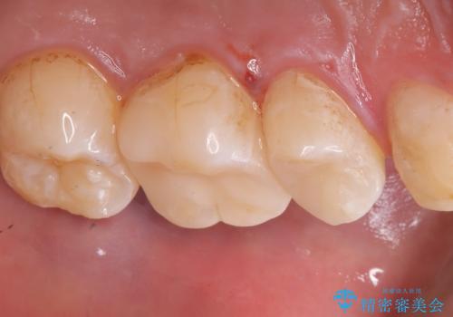 【セラミックインレー】ホワイトニングしに来たら虫歯が見つかったの治療後