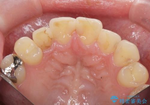 充填物の変色を繰り返す前歯のセラミック治療の治療前