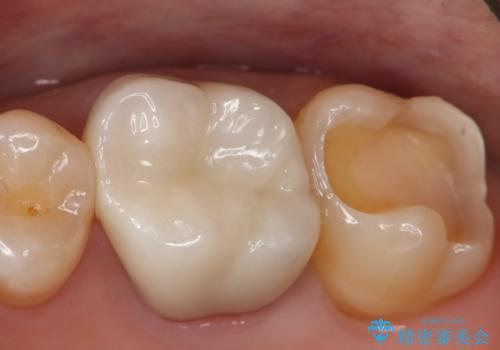 銀歯を白くしたい セラミックインレーの治療中