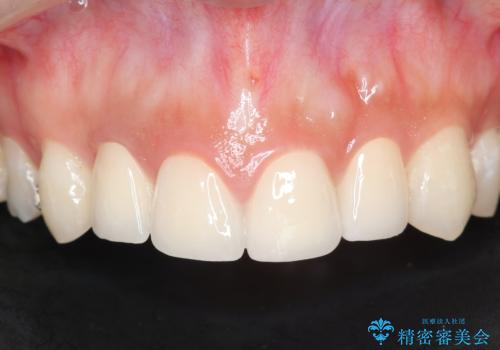 充填物の変色を繰り返す前歯のセラミック治療の症例 治療後