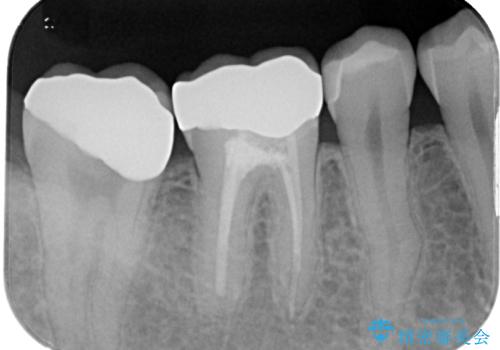 大きな虫歯ができて歯に穴が開いた オールセラミッククラウンの治療後