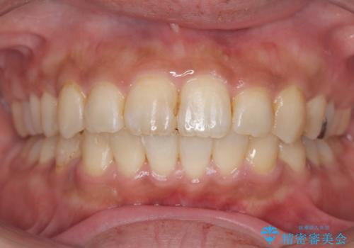 【ワイヤー矯正】前歯の凸凹を治したいの治療後
