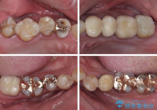 受け口傾向の咬み合わせを治したい 全顎セラミック治療の治療前