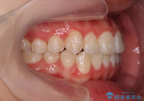 上下すれ違った前歯の矯正治療の治療後