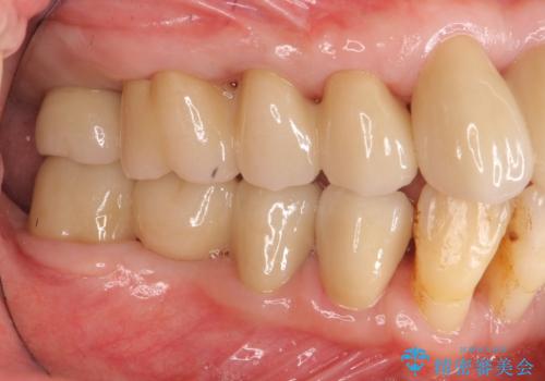 歯周病 、インプラント、 矯正 全顎治療の治療後