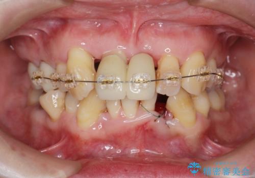 歯周病 、インプラント、 矯正 全顎治療の治療中