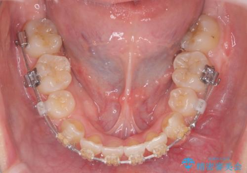 突き出た前歯を治したい 小臼歯抜歯+マルチブラケット矯正の治療中