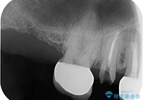 痛く無いインプラント治療!|残根状態の治療の治療前