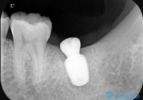 痛くないインプラント治療|1回の手術で終了!|エンドペリオ病変|オールセラミッククラウンの治療中