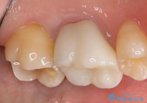銀歯を白くしたい セラミックインレーの治療中