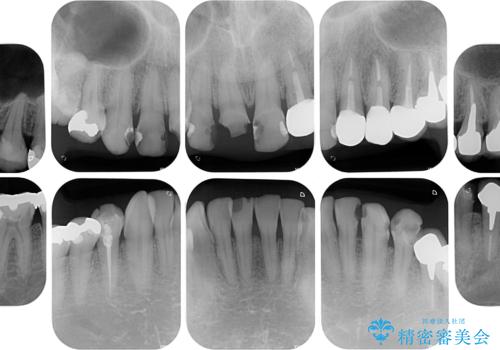 受け口傾向の咬み合わせを治したい 全顎セラミック治療の治療前