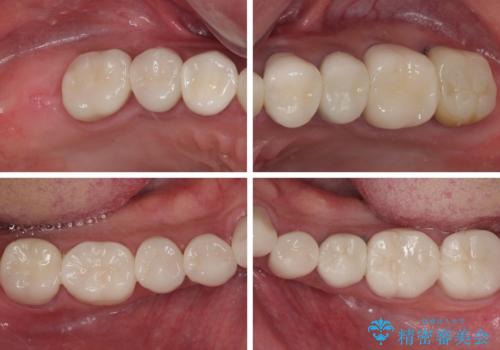 受け口傾向の咬み合わせを治したい 全顎セラミック治療の治療後