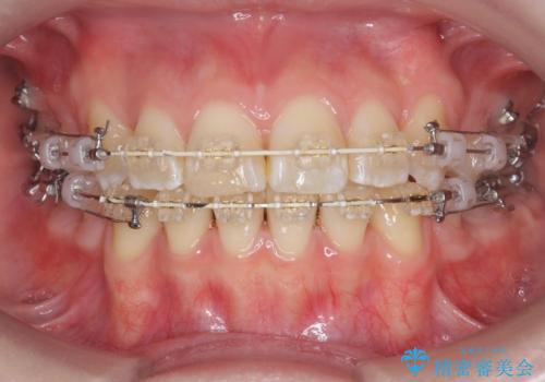 突き出た前歯を治したい 小臼歯抜歯+マルチブラケット矯正の治療中