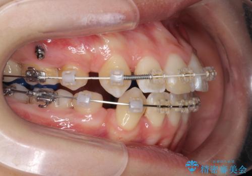 突き出た前歯を治したい 小臼歯抜歯+マルチブラケット矯正の治療中
