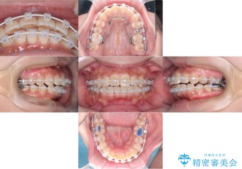 【ワイヤー矯正】前歯の凸凹を治したいの治療中