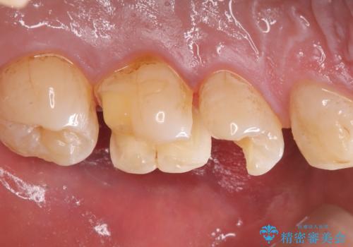 【セラミックインレー】ホワイトニングしに来たら虫歯が見つかったの治療中