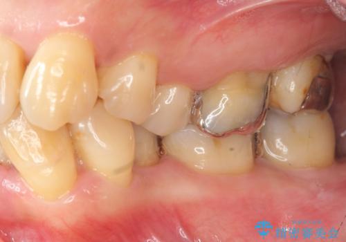 歯周病 、インプラント、 矯正 全顎治療の治療前