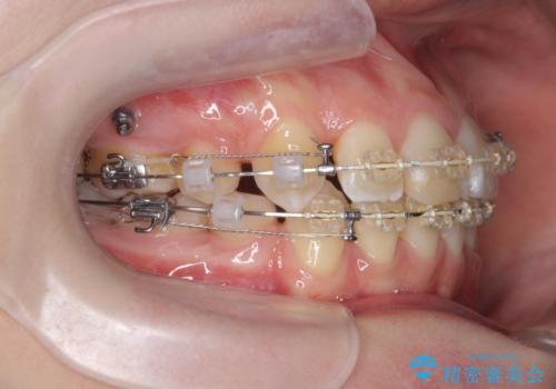 突き出た前歯を治したい 小臼歯抜歯+マルチブラケット矯正の治療中