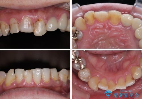 受け口傾向の咬み合わせを治したい 全顎セラミック治療の治療前