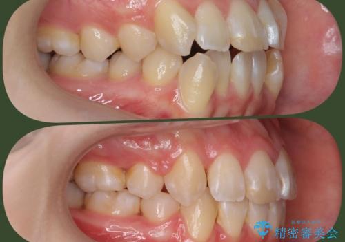 突き出た前歯を治したい 小臼歯抜歯+マルチブラケット矯正