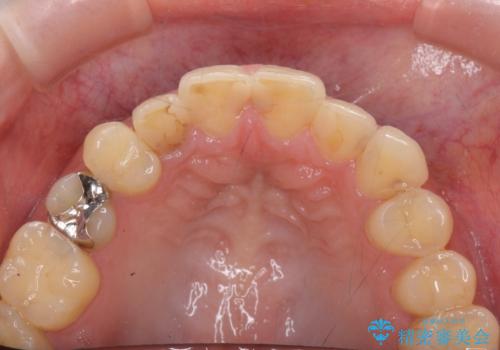 充填物の変色を繰り返す前歯のセラミック治療の治療前