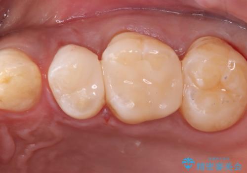 【セラミックインレー】ホワイトニングしに来たら虫歯が見つかったの症例 治療後