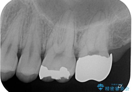 セラミックインレーとクラウンで歯ぐきの腫れを治すの治療前