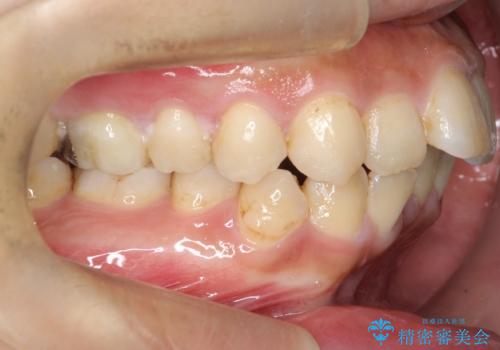 【ワイヤー矯正】前歯の凸凹を治したいの治療前