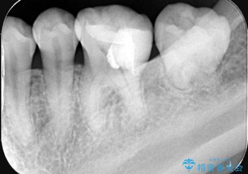 銀歯の下の虫歯|生活歯髄療法|VPT|神経を残すための治療|セラッミクインレーの治療後