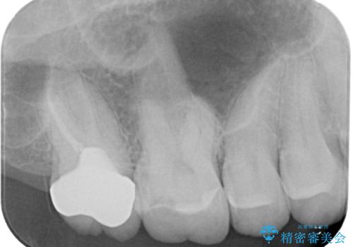 被せものが欠けた オールセラミッククラウンの治療後