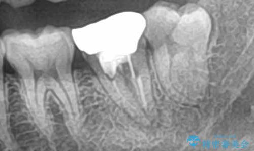 痛くないインプラント治療|1回の手術で終了!|エンドペリオ病変|オールセラミッククラウンの治療前